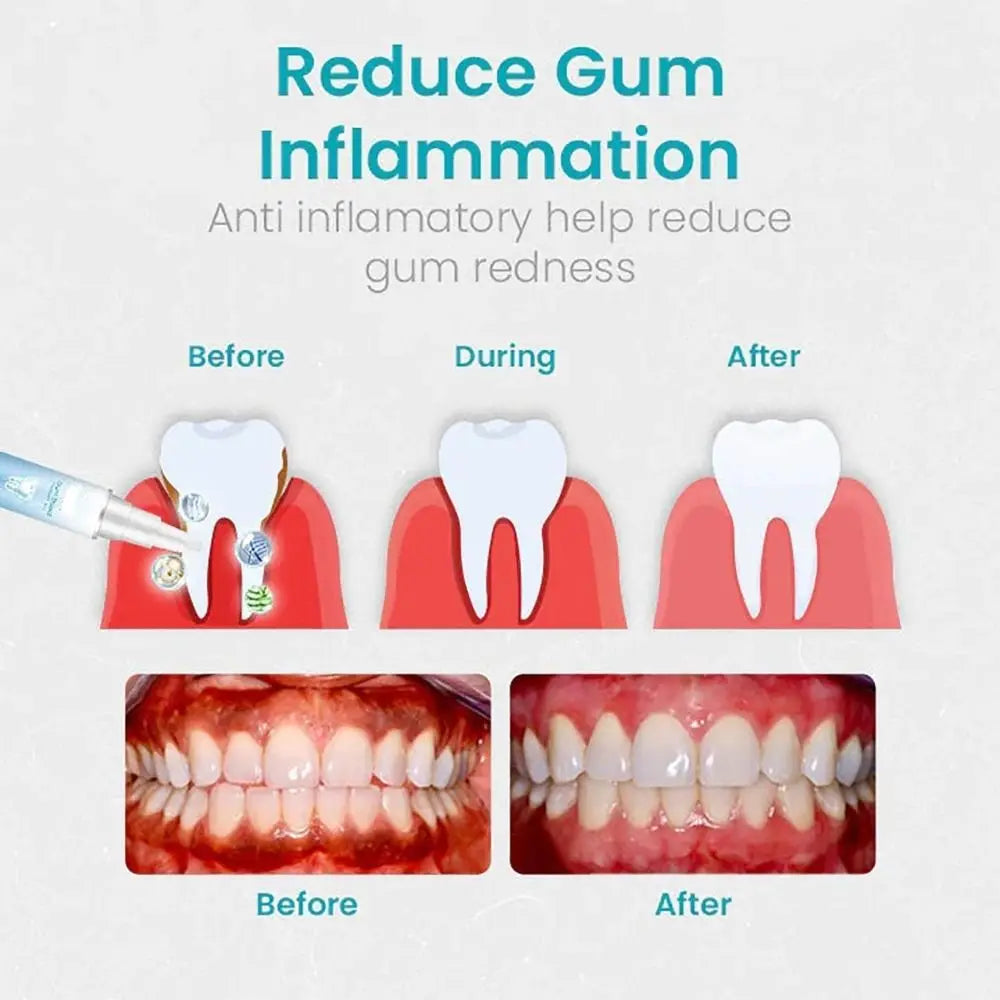 Dental Repair Gum Treatment Gel Reduces Discomfort Reduces Inflammation Gum Shield Therapy Gel Easy to Use Oral Care